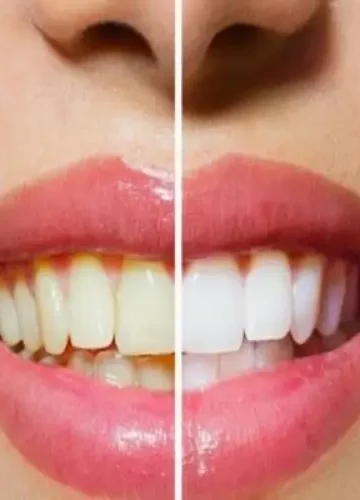Dicas para clarear os dentes em casa naturalmente